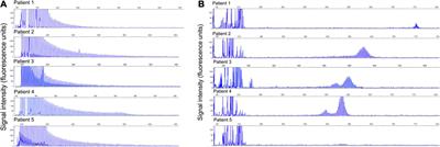 GGC Repeat Expansion in the NOTCH2NLC Gene Is Associated With a Phenotype of Predominant Motor–Sensory and Autonomic Neuropathy